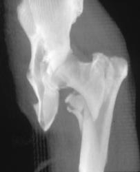 Femoral Fracture - CTisus CT Scan