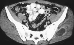 Intramuscular Abscess - CTisus CT Scan