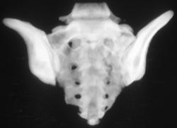 Sacral Fractures on Lt - CTisus CT Scan