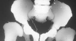 3D of Dysplastic Hips (circa 1985) - CTisus CT Scan