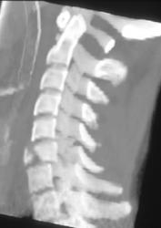 C-6 Fracture - CTisus CT Scan