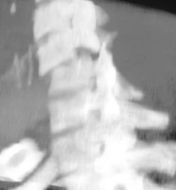 Fracture/dislocation - CTisus CT Scan