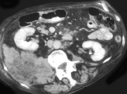 Lymphoma - CTisus CT Scan