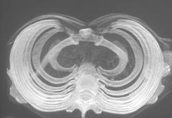 Pectus Deformity - CTisus CT Scan