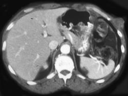 Melanoma - CTisus CT Scan