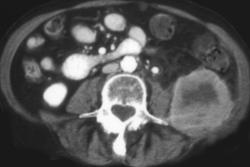 Lymphoma - CTisus CT Scan