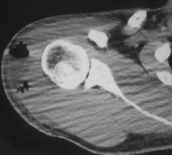 Abscess in Deltoid Muscle - CTisus CT Scan