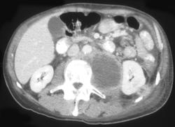 Lymphoma Involves Kidney and Psoas Muscle - CTisus CT Scan