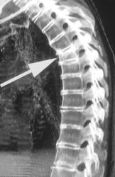 Sclerotic Vertebral Body (dx:breast Cancer) - CTisus CT Scan