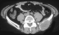 Lymphoma - CTisus CT Scan