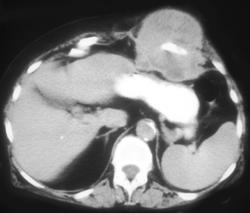 Lymphoma - CTisus CT Scan