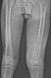 Lymphoma - CTisus CT Scan