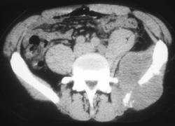 Lymphoma - CTisus CT Scan