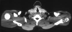 Lymphoma of Lt Scapula - CTisus CT Scan