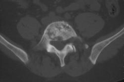 Lymphoma - CTisus CT Scan