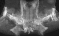 Osteomyelitis of Temporal Bone in A Frog - CTisus CT Scan