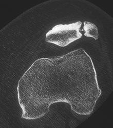 Old Patellar Fracture - CTisus CT Scan