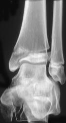 Fracture With Epiphyseal Plate Widening - CTisus CT Scan