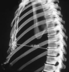 Pectus Pre-op Repair Study - CTisus CT Scan