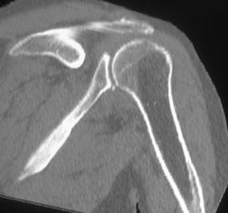 Small Joint Fragment - CTisus CT Scan