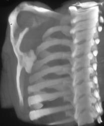 Exostosis of Scapula - CTisus CT Scan