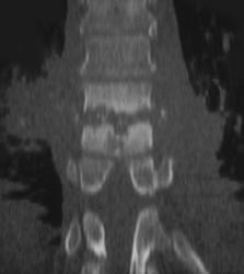 Osteomyelitis - CTisus CT Scan