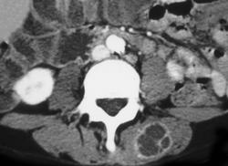 Intramuscular Abscess - CTisus CT Scan