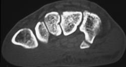 Hamate Fracture - CTisus CT Scan