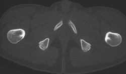 Subtle Symphysis Fractures - CTisus CT Scan