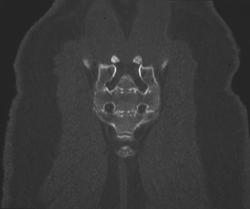 Normal Sacrum - CTisus CT Scan