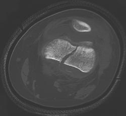 Distal Femur Fracture Involves the Epiphyseal Plate - CTisus CT Scan