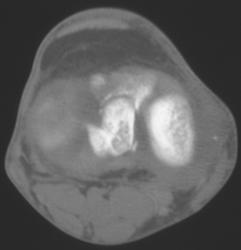 Tibial Spine Fracture - CTisus CT Scan