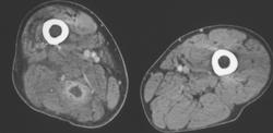 Intramuscular Abscess - CTisus CT Scan