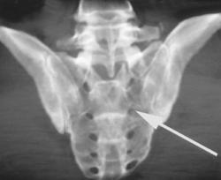 Sacral Fractures - CTisus CT Scan