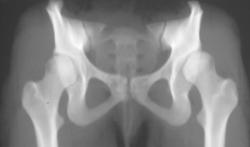 Congenital Hip Dysplasia on Left - CTisus CT Scan