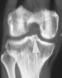 Tibial Spine Fracture (missed on Plain Films of Knee) - CTisus CT Scan