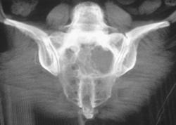 Chordoma - CTisus CT Scan