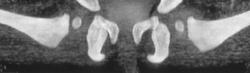 Successfully Reduced Hips in Child - CTisus CT Scan