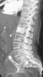 Prostate Cancer - CTisus CT Scan