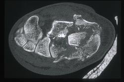 Calcaneal Fracture - CTisus CT Scan