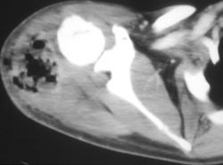 Intramuscular Abscess - CTisus CT Scan