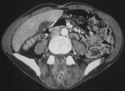 Lymphoma Infiltrates the Spine and Cord - CTisus CT Scan