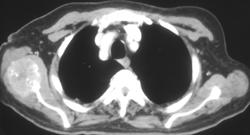 Renal Cell Metastatic to the Right Scapula - CTisus CT Scan