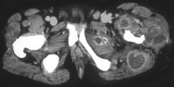 Multiple Muscle Abscesses - CTisus CT Scan