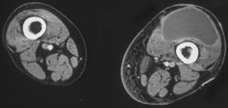 Fibrosarcoma - CTisus CT Scan