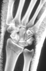 Radial Fracture - CTisus CT Scan