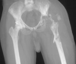 Infected Left Hip Joint Post Arthoplasty With Osteomyelitis - CTisus CT Scan