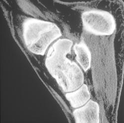 Osteochondrosis Dissecans - CTisus CT Scan