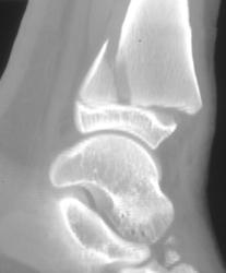 Tibial Fracture Extends Through Epiphyseal Plate - CTisus CT Scan