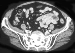 Stress Fracture Sacrum - CTisus CT Scan